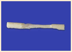 Preshaped Patella Tendon